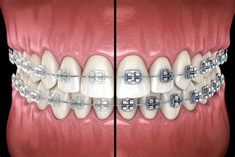 metal brackets vs ceramic|ceramic vs traditional braces.